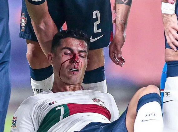 Ronaldo bê bết máu vì bị thủ môn đối phương đấm gãy mũi